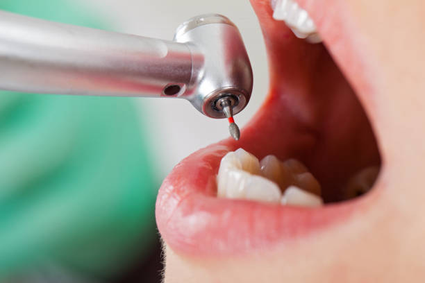 Best Knocked-Out Tooth (Avulsed Tooth) Treatment in Gold Beach, OR